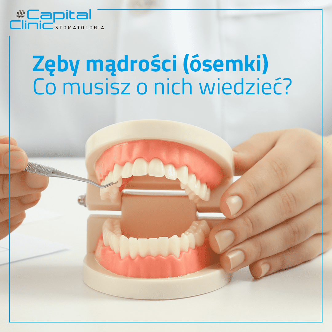 Zęby mądrości