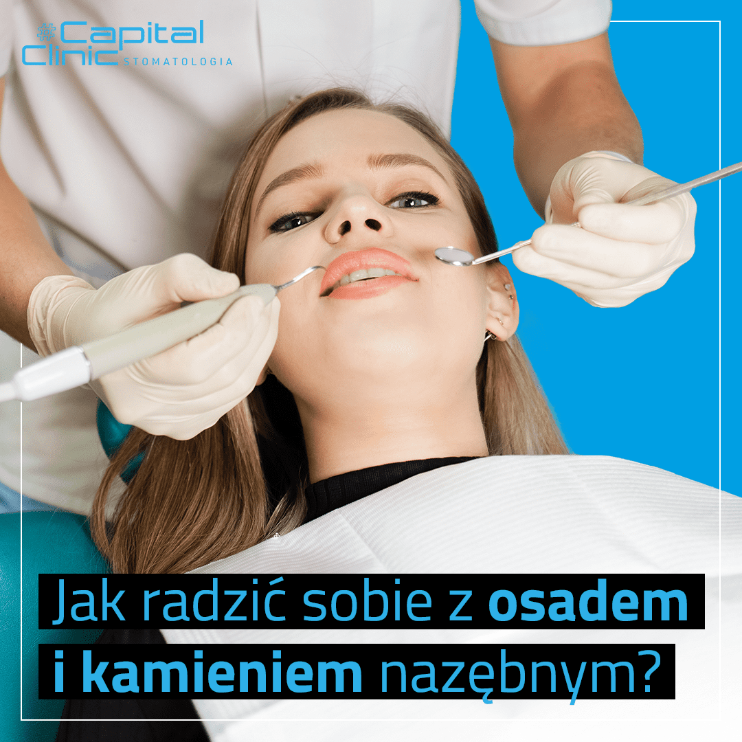 Kamień nazębny