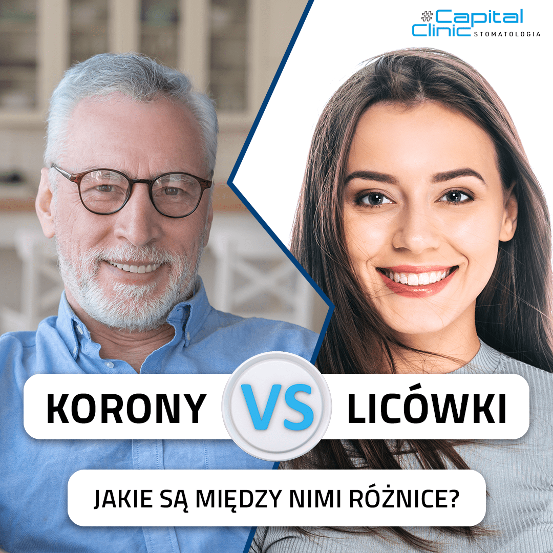 Różnice pomiędzy koronami i licówkami.